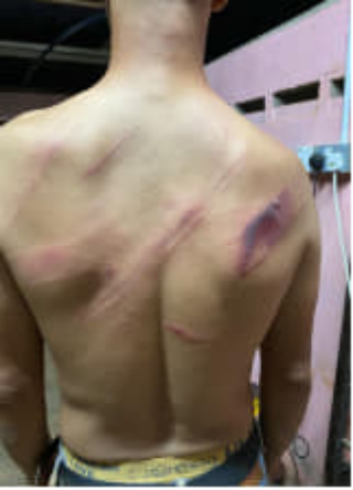 Une personne portant des blessures visibles dans le dos se tient dans une pièce faiblement éclairée aux murs roses, une prise électrique visible.