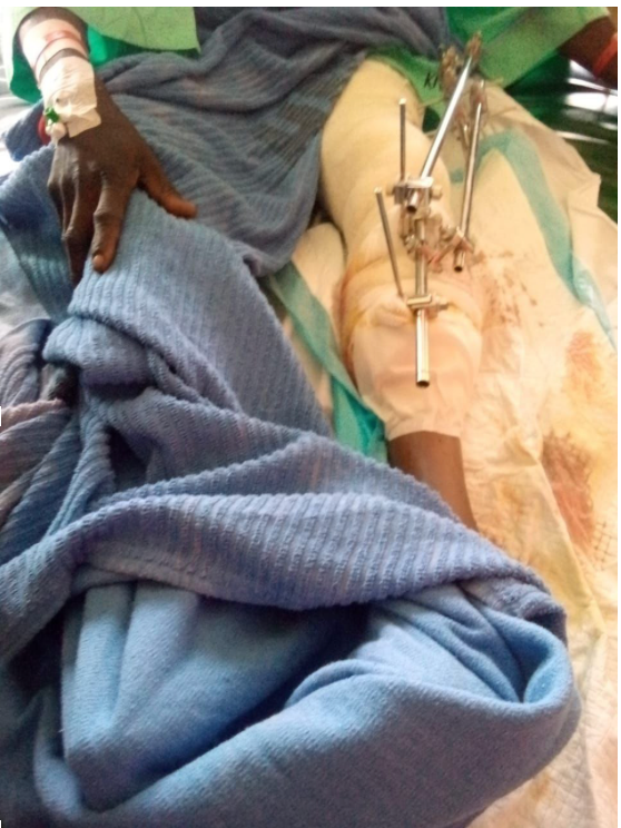 jambe blessée après un tir de la police au Kenya